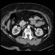 Renal cell carcinoma, small: CT - Computed tomography